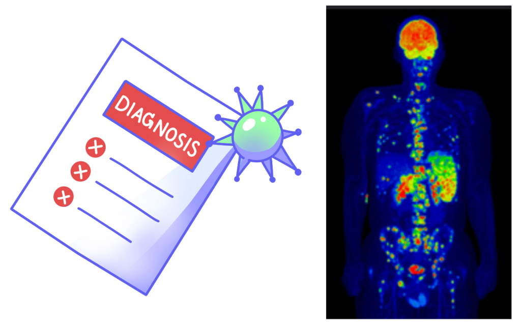 Medical diagnosis chart next to a PET scan showing radioactive tracer uptake in a human body.