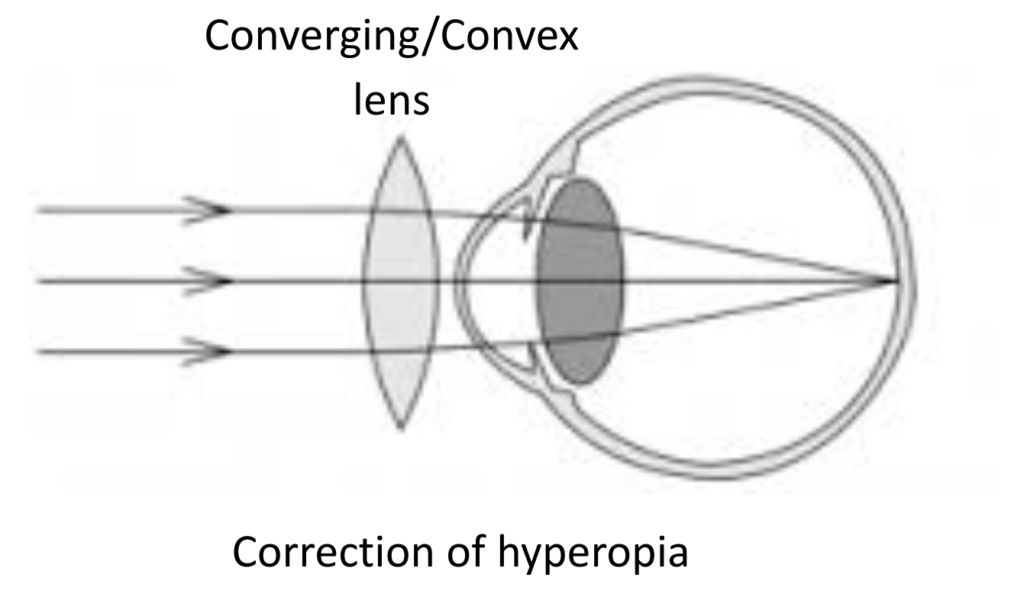 showing a convex lens focusing parallel light rays onto the retina