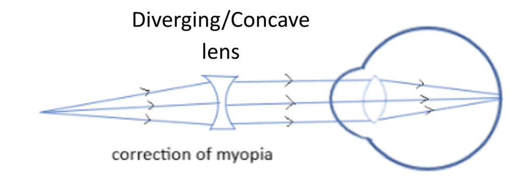 showing correction of myopia using a diverging concave lens