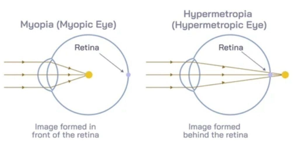 Eye Diagram GCSE showing myopia and hypermetropia with image formed in front of and behind the retina